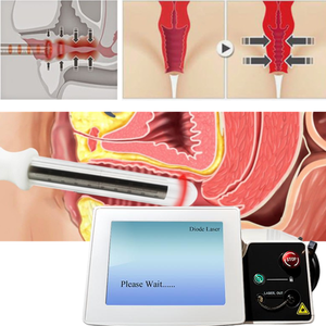 Láser de Diodo Portátil de 1470nm y 980nm para Histeroscopia Vaginal, Tensado de Piel de 980nm, Dispositivo Médico de 360 Grados para <span class=keywords><strong>Tratamiento</strong></span> Ginecológico - Product Image 1