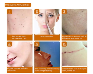 Equipo de belleza láser de última generación de 10600nm para tensado vaginal, láser fraccional de CO2, máquina de láser fraccional de CO2 para uso en salones. - Product Image 6