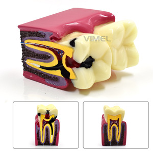 Modelo Dental Wemeile de 24 Dientes, Boca Completa Extraíble, Sección Transversal Ampliada, Dientes Patológicos para Educación - Product Image 5