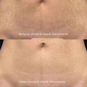 Crème anti-vergetures intensive EGF Crème anti-vergetures réparatrice post-partum Crème anti-vergetures EGF raffermissante pour l'abdomen B - Product Image 6