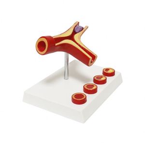 Modelo de Aterosclerosis y Trombosis Humana KyrenMed, Modelo Cardiovascular de Aterosclerosis Ampliado 10 Veces - Product Image 3