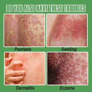 OEM Psoriasis <span class=keywords><strong>Eczema</strong></span> <span class=keywords><strong>Tratamiento</strong></span> Spray Athlete'foot Mano Tiña Dermatitis Antibacteriano Beriberi Anti Picazón Reparación Cuidado <span class=keywords><strong>DE</strong></span> LA PIEL - Product Image 4