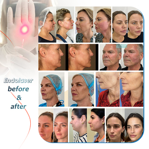 เครื่องลดไขมันด้วยไฟเบอร์เอนโดลิฟติ้ง 980nm และ 1470nm <span class=keywords><strong>ราคา</strong></span>เท่าไหร่ - Product Image 6