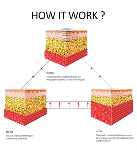 Appareil de tonification corporelle magnétique non invasif 13 Tesla Power - Product Image 3