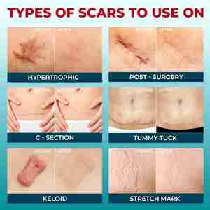 เทปรอย<span class=keywords><strong>แผล</strong></span>เป็นซิลิโคนเกรดทางการแพทย์ที่มองเห็นความแตกต่างที่มองเห็นได้บนแผ่น<span class=keywords><strong>แผล</strong></span>เป็นซิลิโคนแบบใช้ซ้ำได้-ใช้งานง่าย - Product Image 5