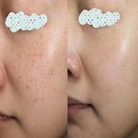 Solution de Peeling Chimique Exfoliant Peau Acide Salicylique Contre l'Hyperpigmentation – Sérum Professionnel Visage et Corps