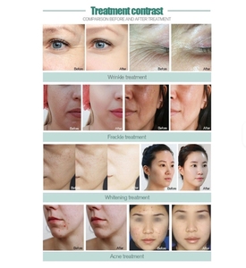 เครื่องผลิตออกซิเจนแบบไม่ต้องผ่าตัดสำหรับทำความสะอาดรูขุมขน ฟื้นฟูผิวหน้า ดวงตา และผิวกาย สำหรับร้านเสริมสวย - โปรโมชั่นลดราคา - Product Image 4