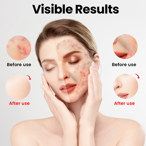 Ideaterapia nuova tendenza Led luce rossa terapia maschera per il viso luce rossa sicura in Silicone rosso Led maschera per il viso per uso domestico - Product Image 3