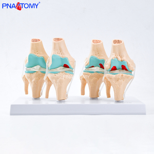 Modelo de Articulación de <span class=keywords><strong>Rodilla</strong></span> Humana de 4 Etapas con Osteoartritis Patológica, Herramienta Educativa para Profesores de Ciencias Anatómicas, Enseñanza Médica - Product Image 1