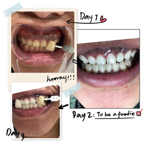 Manufacturers Cheapest Professional Home Best Dental Teeth Whitening System <b>Machine</b> Set Blue Led Light Cleaning Salon - Product Image 4