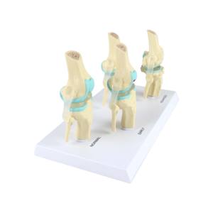 Modèle d'articulation du genou, anatomie humaine, modèle de genou pour l'enseignement de la pathologie, 4 étapes - Product Image 4