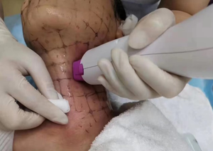 Appareil de lifting thermique professionnel FLX 5ème génération, appareil thermique FLX pour le raffermissement de la peau, appareil de beauté pour le lifting du visage - Product Image 4