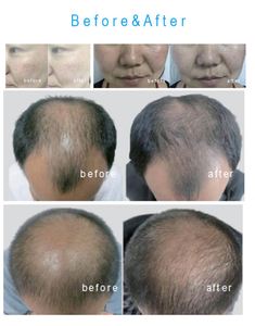 เครื่องเติมน้ำแบบพกพา 2.5 กก. ไม่ต้องใช้เข็ม - ระบบไมโครแชนแนลขนาด 0.05 มม. สำหรับการดูดซึมสูงสุด 5 มล./นาที เหมาะสำหรับสปาและคลินิก - Product Image 5