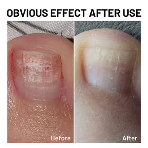 OEM ODM ยาทา<span class=keywords><strong>เล็บ</strong></span>ป้องกันเชื้อรา กำจัดเชื้อรา<span class=keywords><strong>ที่</strong></span><span class=keywords><strong>เล็บ</strong></span>เท้า ซ่อมแซมเล็บที่เปลี่ยนสีและเสียหาย - Product Image 4