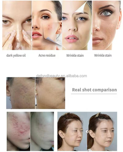 3-in-1 CO2 Oxygen Facial Machine Glo 2 Skin Tightening & Exfoliating with Bubble Jet for Eye Area <b>UK</b> <b>Plug</b> Type - Product Image 6