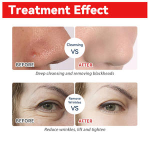 เครื่องไฮดรา บิวตี้ ไฮโดร เดอร์มาเบรชั่น ไฮโดร อควา เฟเชียล สำหรับทำความสะอาดผิว ฟื้นฟูผิว อุปกรณ์สปา ขายจากโรงงาน - Product Image 6