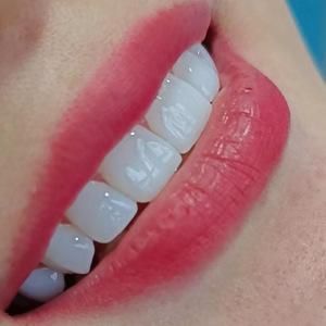 อิโฮก้า ทีธ คัฟเวอร์ วีเนียร์ส สีขาว สำหรับใช้ในบ้าน ตกแต่งฟัน - Product Image 2