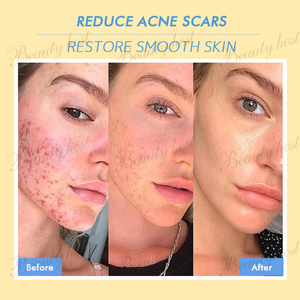OEM/ODM Balance Anti Acne <b>Kit</b> 3pcs Repair Cream 50g Anti Acne Mist 100ml <b>Roll</b>-on Serum 15ml High Quality Anti Acne Skin Care Set - Product Image 4