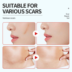Kormesic Hot Selling Private Label Beauty Snelle Verwijdering Puistje <span class=keywords><strong>Acne</strong></span> Spot Behandeling <span class=keywords><strong>Gel</strong></span> Kalmerende Litteken Reparatie <span class=keywords><strong>Gel</strong></span> - Product Image 6