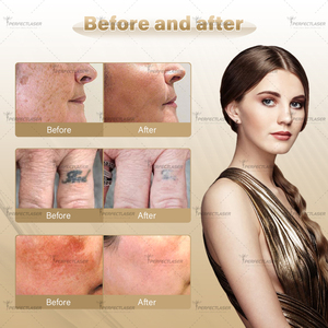 Máquina Láser Nd Yag Portátil para Eliminar Tatuajes, Láser de Picosegundos Qswitch Ndyag para Tratamiento de Pigmentos y Peeling de Carbón - Product Image 5