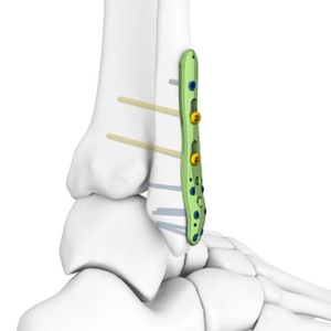 <span class=keywords><strong>Vis</strong></span> à os pour pieds, plaques de fixation pour fractures de la <span class=keywords><strong>cheville</strong></span> - Product Image 5