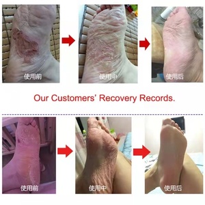 Free Shipping Herbal Athlete <b>Foot</b> <b>Cream</b> Peeling Fungus Treat <b>Foot</b> <b>Odor</b> Itching Blisters Ointment Cellulite Body Care Nourishing - Product Image 2