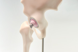 Modello di Sostituzione dell'Anca in Scala Ridotta per Comunicazione Clinica tra Ortopedisti e Pazienti - Product Image 2