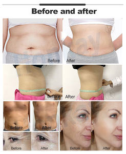 Apparecchiatura Fisioterapica Smart Tecar a Onde Corte, Macchina per Terapia Diatermica Tecar - Product Image 6