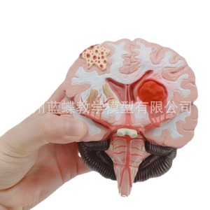 Anatomía del cerebro humano; modelo de cerebro/ictus; modelo de enfermedad cerebral; hemorragia cerebral; modelo anatómico de lesiones cerebrales. - Product Image 4