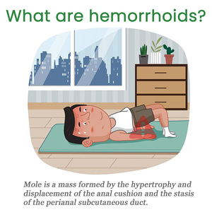 Ungüento Herbal para <span class=keywords><strong>Hemorroides</strong></span> al por Mayor, Alivia el Dolor, Sangrado Anal, Hinchazón, Fisura Anal, Spray para <span class=keywords><strong>Hemorroides</strong></span> - Product Image 5