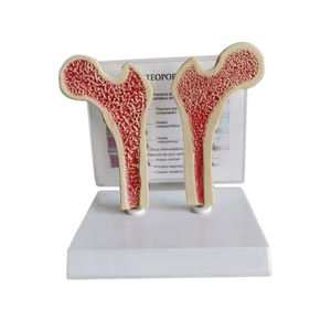 Gran Venta de patología de la osteoporosis y modelo de enseñanza de densidad ósea saludable para estudiar - Product Image 1