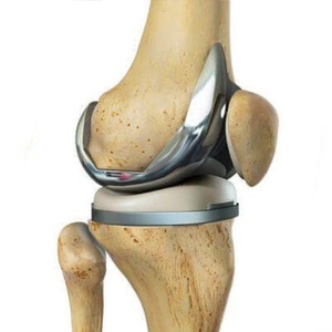 Implante de Reconstrucción de Rodilla, Prótesis de Reemplazo <span class=keywords><strong>Total</strong></span> Primario de Articulación de Rodilla para Uso Quirúrgico - Product Image 1