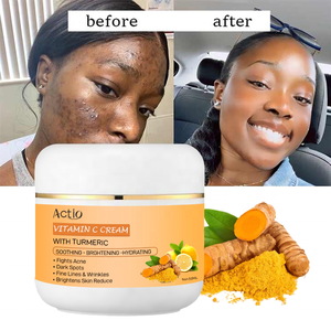 Atacado <span class=keywords><strong>Acne</strong></span> Cicatrizes Remoção Creme Clareamento Rugas Removendo Rosto Clareamento <span class=keywords><strong>Acne</strong></span> Creme Puro para Mulheres