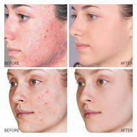 Meilleur collagène végétalien en poudre lyophilisée 100% naturel biologique à l'arbre à thé pour réparer les cicatrices d'acné, les pores fins, les soins de la peau du visage OBM