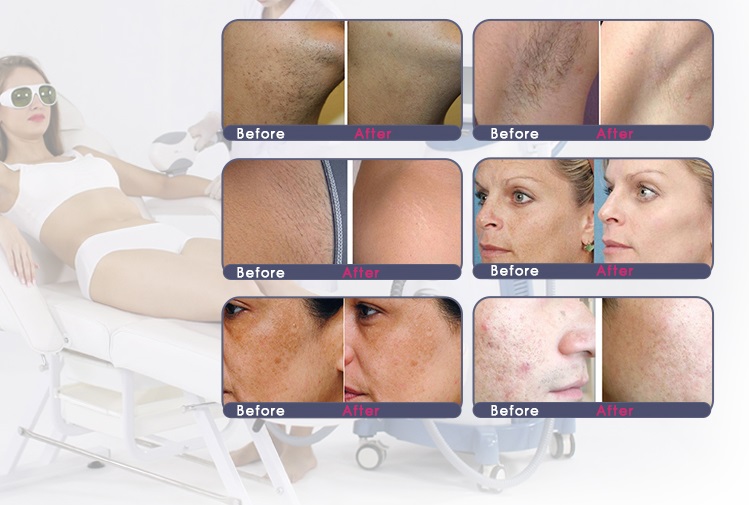 beauty spa အမြန် depilacion OPT SHR Hair Removal အမြဲတမ်းဆံပင်ဖယ်ရှားစက်