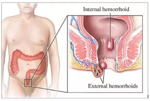 Tratamiento con láser de diodo para cirugía clínica hospitalaria, 2023 + 1470nm, proctología, hemorroides, Anal, 980nm - Product Image 3