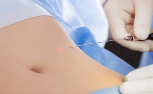 Vente flash - Appareil de liposuccion <span class=keywords><strong>laser</strong></span> à diode portable 980 nm, machine de lipolyse <span class=keywords><strong>laser</strong></span> 980, endolaser lifting - Product Image 5