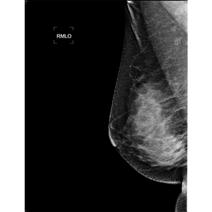 Mesin Mammografi <span class=keywords><strong>Digital</strong></span> 5kW untuk Dijual - Product Image 5