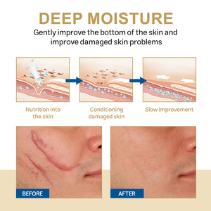 OEM ODM forte e efficace per l'acne segna la nuova vecchia crema per la rimozione delle cicatrici brufoli smagliature rimuovono la crema per stringere la pancia - Product Image 6