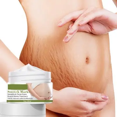 Private Label Kruidenextract Body Skin Anti Strech Marks Zwangerschap Mango Stretch Mark Verwijderen Crème