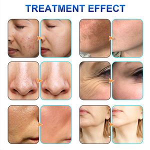 <span class=keywords><strong>2025</strong></span> Promotie 10in1 Hydra Huid Hoge Frequentie Gezichts Vacuüm Mee-Eter Verwijderaar Dermabrasie 10 En 1 Hydrodermabrasie <span class=keywords><strong>Machine</strong></span> - Product Image 6