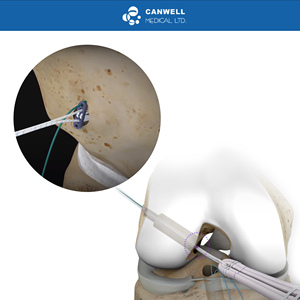 CANWELL Arthroscopie Implants ACL Endobutton Renforcé Bouton Cl ultra Sports Médecine Médicale Orthopédique - Product Image 5
