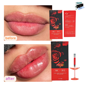 Lot de 1 ml – <span class=keywords><strong>Injection</strong></span> pour lèvres rouges – Acide hyaluronique – Remplisseur dermique – Sérum injectable VB12 pour éclaircir la couleur des lèvres – 1 ml - Product Image 1