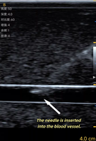 Modèle de formation en coloscopie pour l'enseignement en sciences médicales, modèle d'organe colonique souple de simulation, modèle de colon en gel auto-réparateur