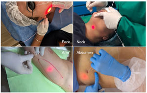 Endolaser mesin lipolysis lemak laser dioda sedot lemak canula 1470nm serat laser body countring spa optik angkat wajah - Product Image 5