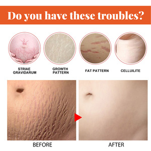 Logo personnalisé crème anti-vergetures de <span class=keywords><strong>grossesse</strong></span> crème pour le <span class=keywords><strong>corps</strong></span> crème anti-vergeture réparatrice crème anti-cicatrice - Product Image 6