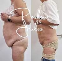Máquina de Adelgazamiento Corporal con Liposucción Vaser de 980nm, Láser Diodo de 1470nm para Lipólisis, Endoláser para Lifting Facial