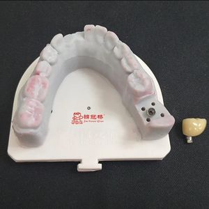 Impianto dentiere il modo migliore per trattare la perdita dei denti. Non danneggiare i denti adiacenti, evitare vicino al carico di forza del morso dei denti - Product Image 3