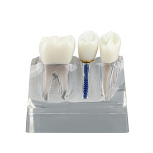 Modèle d'implant dentaire pour l'éducation des patients, modèle d'implant dentaire, de couronne et de pont 4 fois plus grand pour la présentation - Transparent - Product Image 4