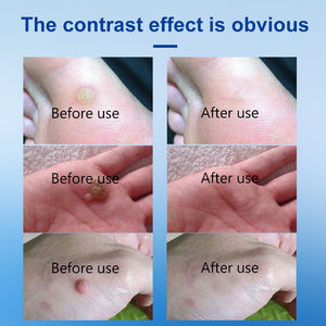 REINREUDEウォートリムーバー液体-一般的でフラットなウォート処理のためのベストセラー - Product Image 5